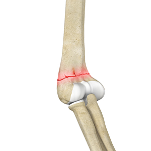 Elbow Fractures
