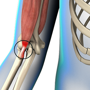 elbow tendonitis