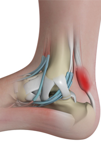 Achilles Tendinitis