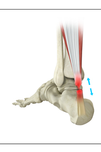 Achilles Tendon Rupture