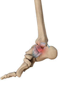 Ankle Sprain or Ankle Ligament Injury
