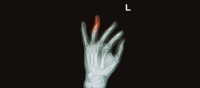Hand Injury