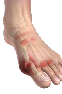 Ankle Rheumatoid Arthritis