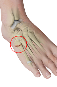 Stress Fracture of Foot and Ankle